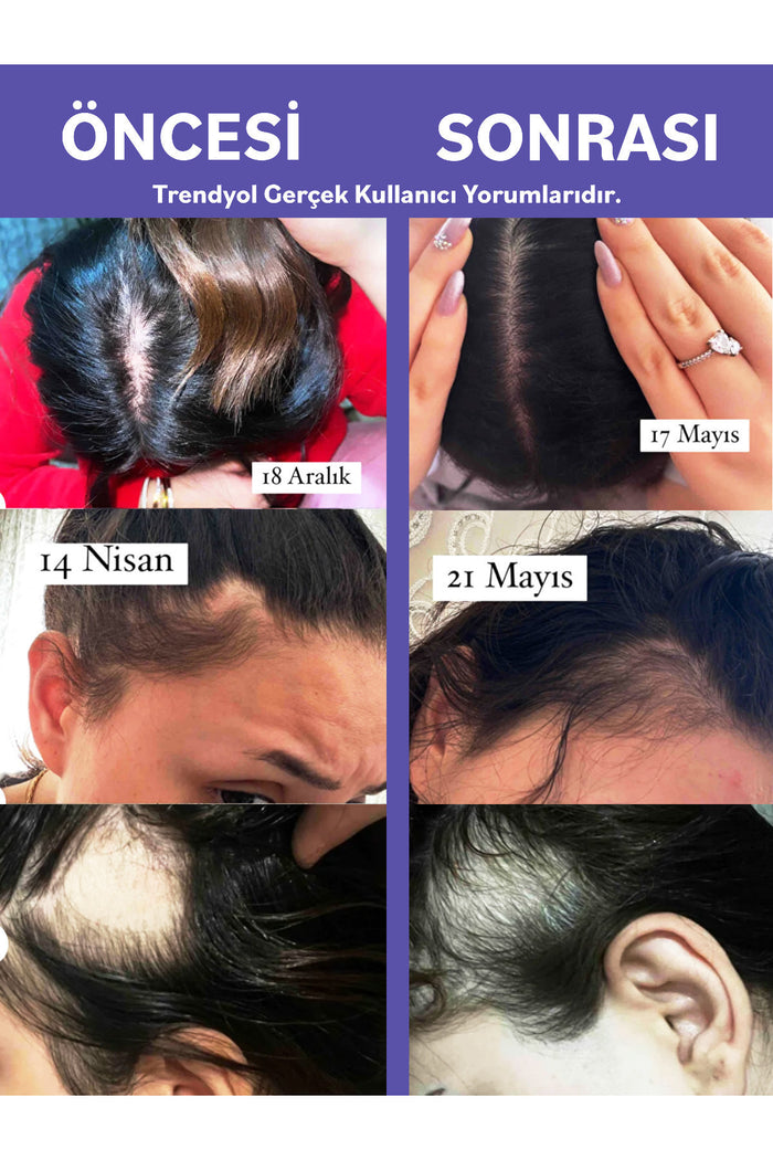 Radix Anti Hair Loss Serum Spray is a targeted scalp treatment formulated with 5% Procapil™ complex to help reduce hair shedding, strengthen hair fibers, and support faster, healthier-looking growth.